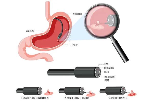 Endoscopic Surgeries